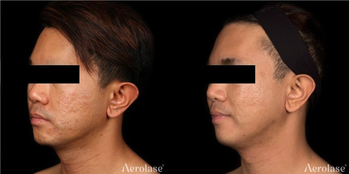 Acne scars and texture