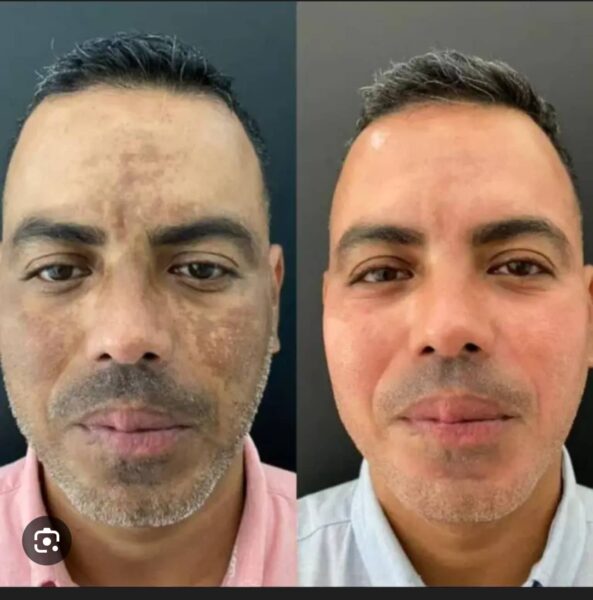 Melasma