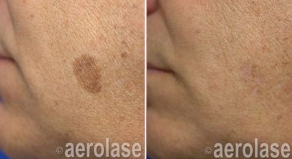 Pigmentation and dark spots