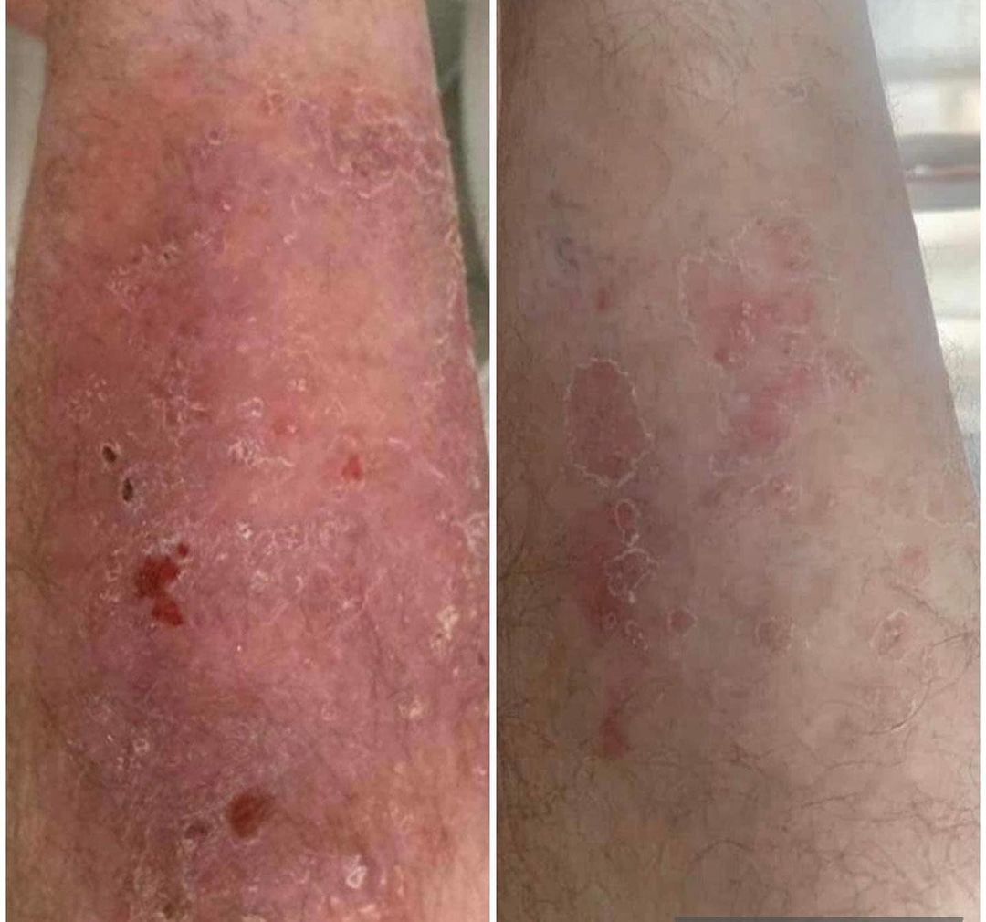 Psoriasis